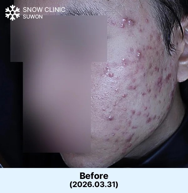 여드름치료 시술 전 사진