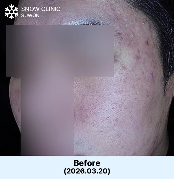 여드름치료 시술 전 사진