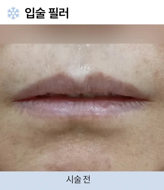 필러 시술 전 사진