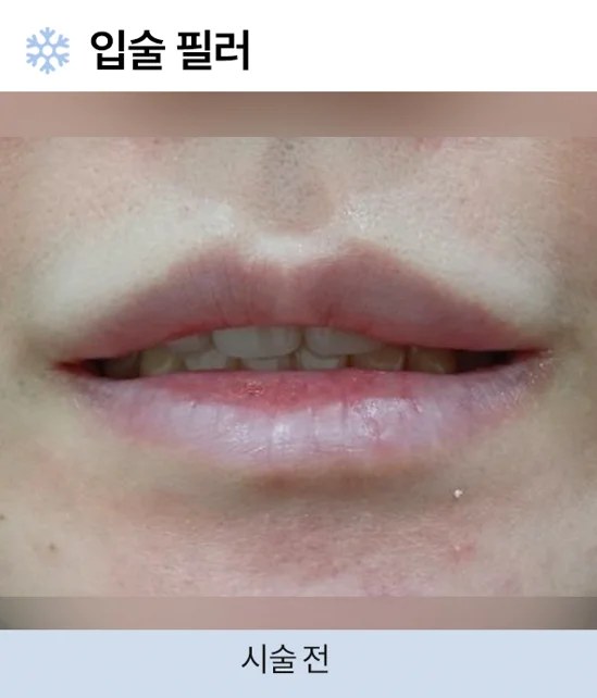 필러 시술 전 사진