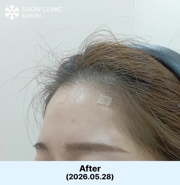 필러 시술 후 사진